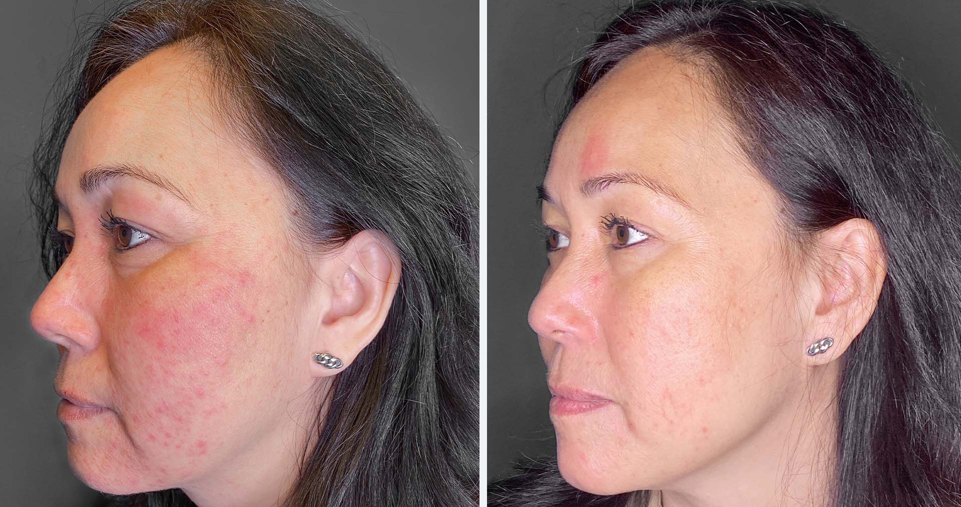 Nurturing Generations LLC | MicroNeedling