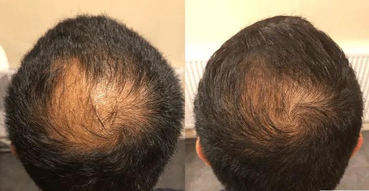 Nurturing Generations LLC | MicroNeedling